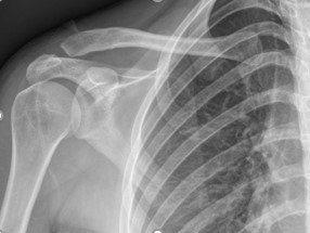 Acromioclavicular (AC) joint Surgery