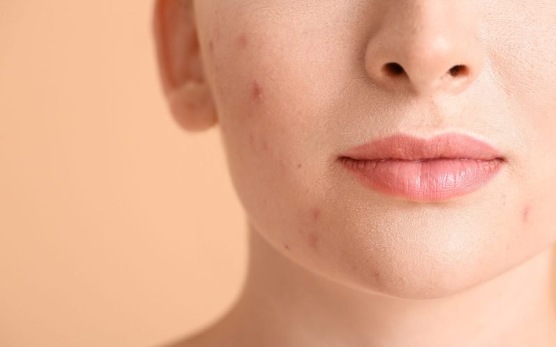 What does hormonal acne look like?