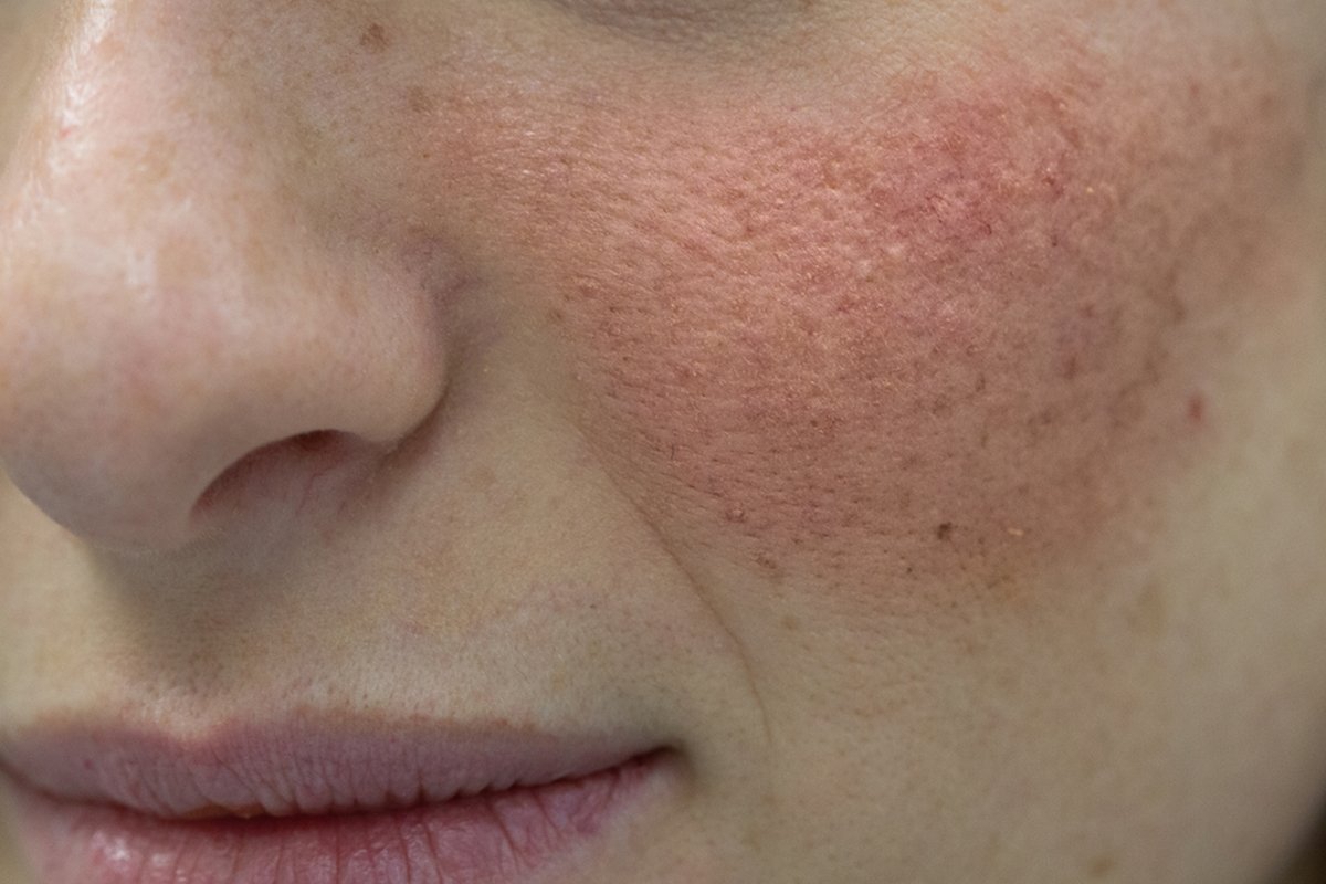 open pores