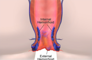 Hemorrhoids