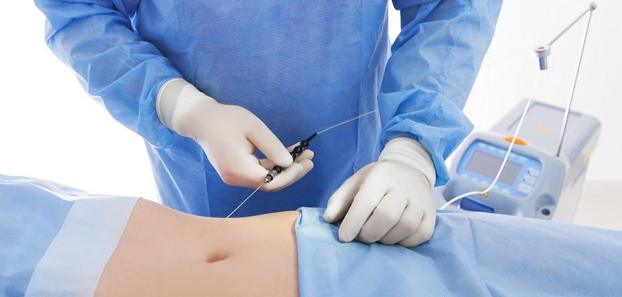 Vaser Liposuction