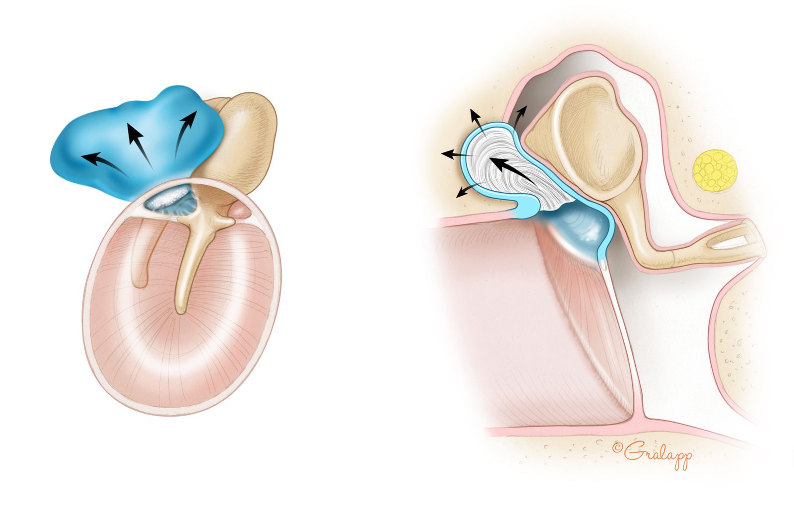 Cholesteatoma