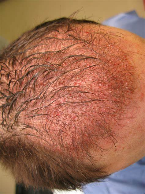 hair transplants