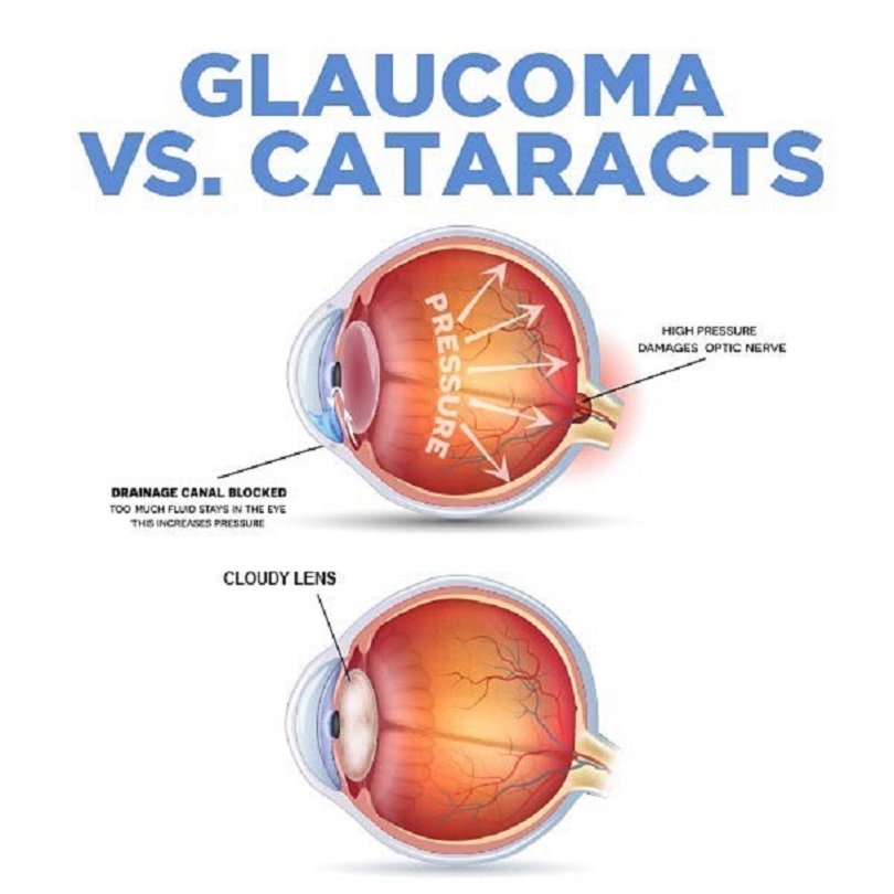 glaucoma vs cataract