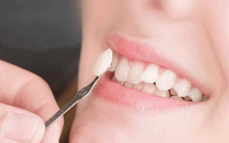 Porcelain Veneers Vs. Dental Bonding: Which Is The Best?￼