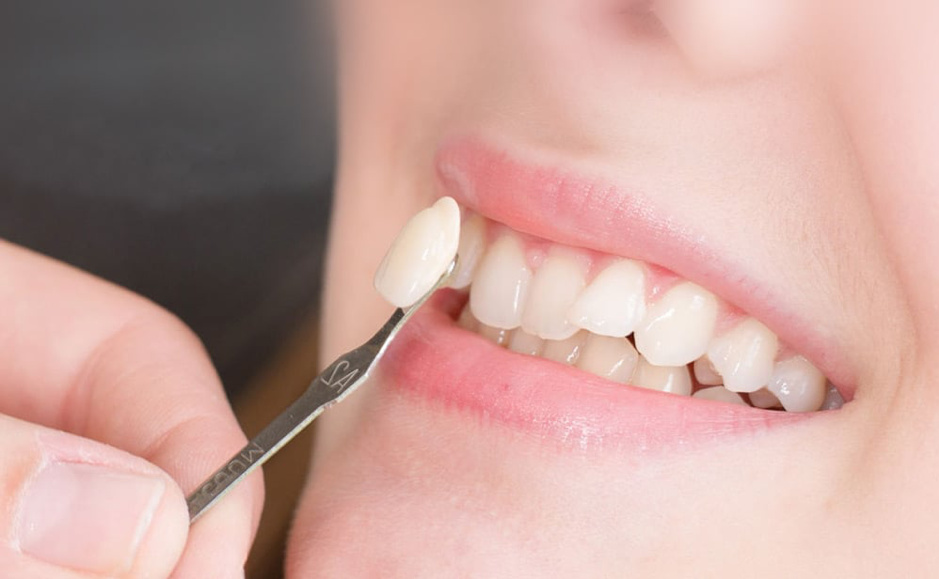 Porcelain Veneers