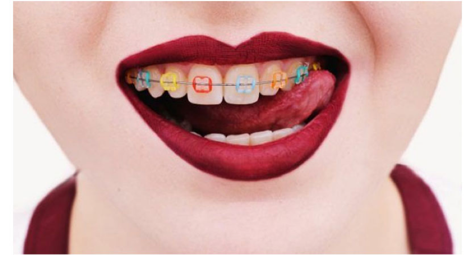 Love brackets. Брекеты красные губы.