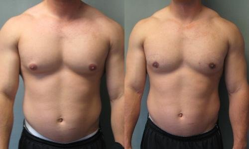 <strong>Advantages of gynecomastia treatment</strong>